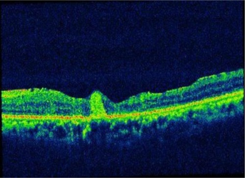 Figure 3 Optical coherence tomography image depicting residual triamcinolone at the macular hole.