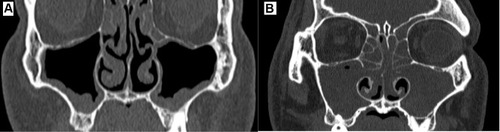 Figure 2 Comparison of maxillary sinus CCAD (A) vs nonCCAD (B) features. Scale bar, 1 cm is equal to 5 cm.