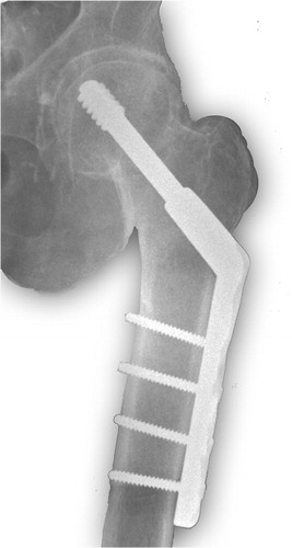 Figure 9. Gliding hip screw.