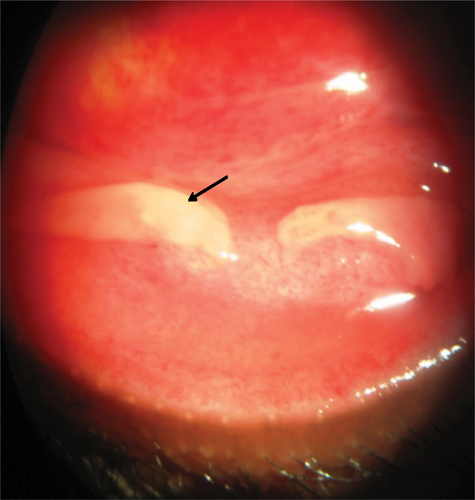 Figure 2 Slit-lamp photography of inferior palpebral conjunctiva with pseudomembrane (black arrow) in a patient with adenoviral keratoconjunctivitis.
