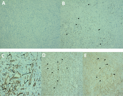 Figure 3 Immunohistochemistry (A) HHV-8(-), (magnification,x100). (B) Ki-67(+) (black arrows), (magnification,x100). (C) Vascular endothelial cells CD34(+) (black arrows), mesenchymal cells CD34(-) (magnification,x200). (D) Fli-1(+) (blackarrows), (magnification,x100). (E) VEGF(+) (black arrows), (magnification,x100).