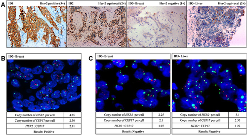 Figure 2 Her-2/HER2 status in the tissue of the 3 patients. (A) The Her-2 protein expression in the primary tissue of patient ID1, ID2, and ID3, and in the liver metastasis tissue of patient ID3 were detected by IHC test. (B) The copy number of HER2 gene in the tumor tissue of patient ID2 was detected by FISH test. (C) The copy number of HER2 gene in the primary and liver metastasis tissue of patient ID3 were detected by FISH test.