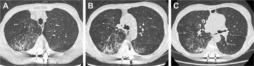 Figure 2 High-resolution computed tomography of the chest confirmed the presence of ground-glass opacities with subpleural sparing, interlobular septal thickening, a crazy-paving appearance, and traction bronchiectasis (A–C). Emphysema was also present in both upper lobes.