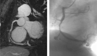 Figure 1. Stenosis of the right coronary artery. Contrast-enhanced MRCA (left) and catheter angiography (right).