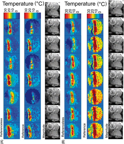 Figure 4. Comparison of seven consecutive acquisitions under free breathing of a sagittal plane in patient liver at two different stages of the in-progress laser ablation in patient 2: (A) temporal window approximately 4 min from starting the procedure; (B) temporal window after approximately 7 min from starting the procedure. Referenceless and reference phase subtraction MRT (shown FOV = 70 mm, relative values from baseline) and corresponding magnitude images (shown FOV = 200 mm) are presented together. Calculated relative values of temperature below − 10°C are displayed with dark blue. The circular contour overlaid on magnitude images is the inner border of the Dirichlet's domain (optionally opened). The last magnitude image of each series corresponds to the reference scan. Before laser energy is applied, the optical fibre tip is not visible in the magnitude images. A linear colour code has been used for the temperature elevation above the physiological baseline of 37.2°C.