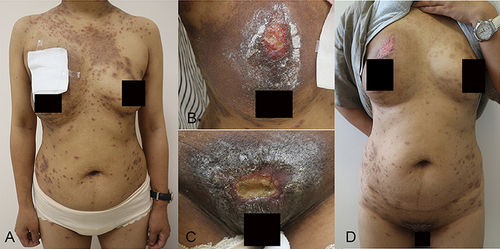 Figure 2 Clinical manifestations in a 38-year-old female with PG and eczema. Scattered ulcers with a small amount of pus on the surface were seen on the right chest and vulva. The ulcers were surrounded by erythema and hyperpigmentation. There were scattered erythema, claw marks, and crusts on the trunk. (A–C) and after 4 months of treatment with baricitinib. Pinkish scarring was seen on the right breast and vulva. There was scattered pigmentation on the trunk. (D).