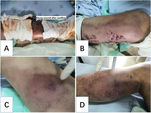 Figure 4. Changes in the physical signs of the patient. Cyanosis, multiple blisters, and ecchymosis around the sting wound (A). Cyanosis, multiple blisters, and ecchymosis spread to the left thigh (B). Similar cyanosis, multiple blisters, and ecchymosis appeared on the right lower limb (C and D).