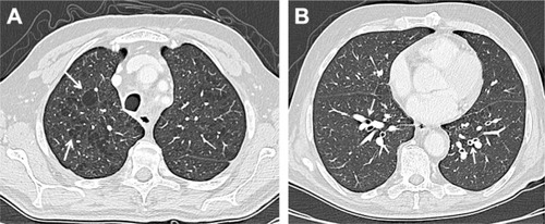 Figure 1 Chest CT on axial planes. Chest CT usually shows emphysema which can be centrilobular, panlobular or paraseptal; the first one is the most common type of emphysema (A), usually related to smoking status and more marked in the upper lobes; the parenchymal destruction is centered around the terminal bronchiole, representing the center of the secondary pulmonary lobule. Other findings include bronchial wall thickening (B), air trapping and narrowing of the trachea in the coronal plane.