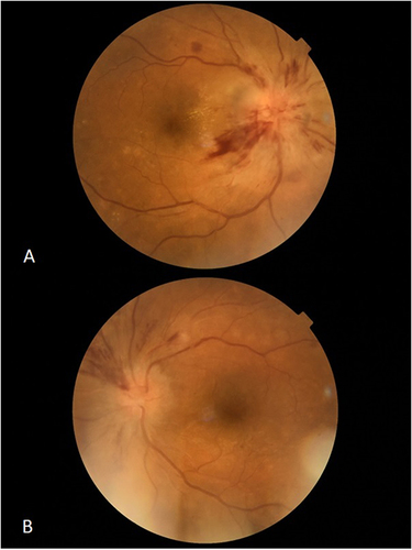 Figure 6 Bilateral optic neuritis associated with Covid-19 disease with no evidence of infection other than SARS-CoV-2 virus in a 45-year-old male patient. (A) right eye, (B) left eye (Picture from the collection of the Ophthalmology Department, Medical University of Bialystok).