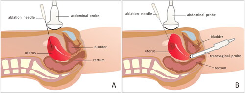 Figure 1. Ablation of uterine myomas using different ultrasound-guided techniques. A. Transabdominal ultrasound guidance. B. Combined transabdominal and transvaginal ultrasound guidance.