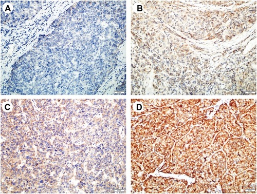 Figure 1 Representative IHC staining of PME-1 in HCC. Representative images of PME-1 immunohistochemical staining from HCC patient samples used for correlation analysis. (A) Negative, (B) weak, (C) moderate, (D), strong. Scale bars = 50 μm.