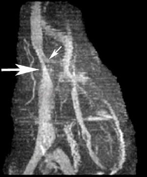 Figure 2. MRA of IVC shows patent IVC with area of flattening secondary to right perirenal hematoma (large arrow). The left renal vein is visualized and patent (small arrow). Compressed right renal vein secondary to right perirenal hematoma is not visualized on the MRA.