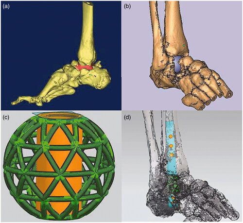 Figure 3. The design of titanium implant for 3DP based on the results of 3D reconstruction of CT scanning (a–c). The preoperative planning by computer assistance for the placement of Retrograde interlocking intramedullary nail (d).