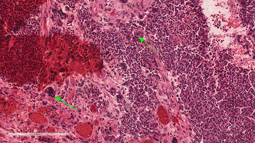 Figure 1 Showing a tumor with anaplasia X200. The green arrows show large cells with irregular nuclear membranes, hyperchromasia, and mitoses.