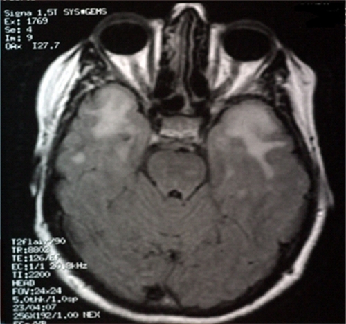 Figure 4 Magnetic resonance imaging scan of the brain showing hyperintensities involving the temporal poles in the patient with cerebal autosomal dominant arteriopathy with subcortical infarcts and leuoencephalopathy.