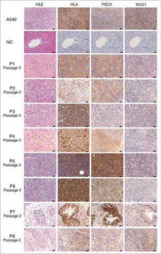 Figure 2. Sections of tumors from eight patient-derived xenograft (PDX) models. Representative images correspond to tumors derived from eight patients; all sections were stained with hematoxylin and eosin (H&E) and antibodies against human leukocyte antigen (HLA), PSCA and MUC1. The passage numbers of each PDX for the patients were indicated. The negative controls (NC) are the liver tissues from a same mouse of third passage of PDX for patient P3. Scale bar = 20 μm. PSCA and MUC1 detection results are also shown in Table 1.