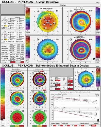 Figure 1. Pentacam maps of a keratoconus patient A) 4 Maps refractive output showing specific tomographic features of keratoconus. B) Belin Ambrosio enhanced ectasia display of the same patient showing all BAD indices including BAD-D in red indicating keratoconus.
