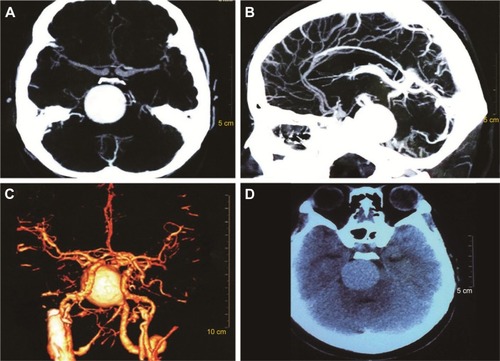 Figure 2 Craniocerebral CT scan (D) and CTA (A–C) show spherical, high-density shadow to the right of the basilar artery. The size was about 3.0 cm×2.8 cm. P1 of the left posterior cerebral artery was dilated, and the vertebral artery showed a shift to the left due to compression.