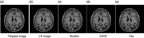 Figure 7. Comparison of the reconstructed images of various methods for noisy medical image (Equation2(2) α=argminα∥α∥0,s.t.∥x−Φα∥2≤ε(2) ) (a) Original image (b) LR image (c) Bicubic (d) ASDS (e) Our.