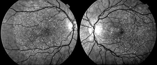 Figure 1 Infrared images showing a typical pattern of “starry sky” fundus with numerous tiny glittering crystal deposits throughout the entire posterior pole of a patient with BCD (both eyes).