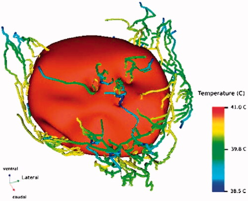 Figure 3. The vessel network in a prostate, together with the simulated 40.5 °C iso-temperature surface for a homogenous SAR level of 20 W kg−1. Pre-heating of the prostate vessels differs from vessel to vessel [Citation44]. This picture has been reproduced from Van den Berg et al. (Towards patient specific thermal modelling of the prostate. Phys Med Biol 2006;51:809–25. http://dx.doi.org/10.1088/0031-9155/51/4/004). © Institute of Physics and Engineering in Medicine. Published on behalf of IPEM by IOP Publishing Ltd. Reproduced by permission of IOP Publishing. All rights reserved.