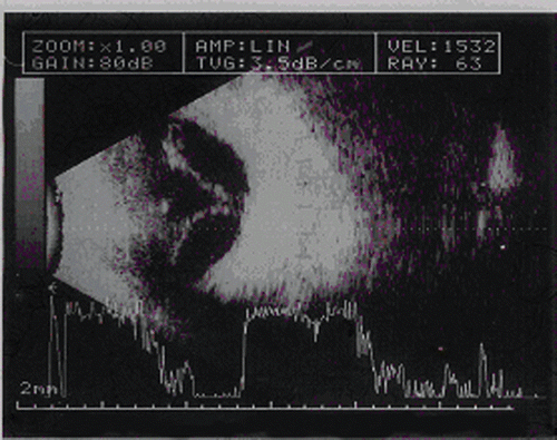 FIGURE 5  Ocular ultrasound - Choroidal Detachment.