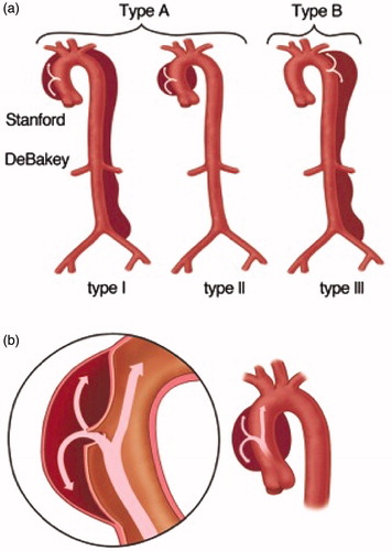 Figure 1. (a) Types of aortic dissection according to the Stanford classification system (shown at top) and the DeBakey classification system (shown at bottom). (b) Intimal tear and propagation of the dissection between the media and intima layers of the ascending aorta. Drawings: Hjördís Bjartmarz. Copyright ©Tomas Gudbjartsson.