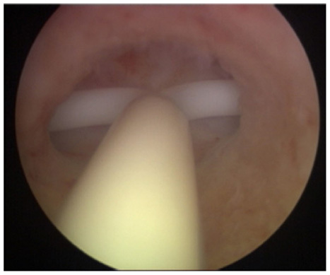 Figure 2 A case of severe incompatibility between the intrauterine device and the narrow uterine cavity.