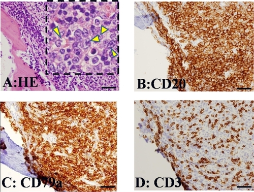 Figure 2 Histological features of the resected specimen. (A) Resected specimen revealed diffuse proliferation of atypical lymphoid cells in the ethmoidal sinus. Insert: There are large-sized cells with prominent nucleoli (arrowheads). These cells express CD20 (B) and CD79a (C), but do not express CD3 (D). These immunohistochemical reactions are consistent with that of diffuse large B cell lymphoma.