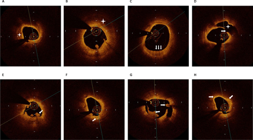 Figure 1 Representative cross-sectional optical coherence tomography images. (A) Calcification identified by the presence of a well-delineated, low-backscattering heterogeneous region (asterisk). (B) Lipid plaque (asterisk) most often appears as diffusely bordered, signal-poor regions with overlying signal-rich bands. (C) Macrophage infiltration (arrow) defined as a signal-rich, distinct or confluent punctate region of higher intensity than background speckle noise that generates remarkable backward shadowing (D) Plaque rupture identified by disruption of the fibrous cap and cavity formation (asterisk). The area where the plaque ruptures was marked by arrow. (E) Plaque erosion identified by the presence of attached thrombus (arrow) overlying an intact plaque. (F) Microvessels defined as tubule luminal structures that do not generate a signal, with no connection to the vessel lumen (arrow). (G) Red thrombus consists mainly of red blood cells; relevant OCT images are characterized as high-backscattering protrusions with signal free shadowing (arrow). White thrombi mainly consisted of white blood cells (WBCs) and platelets and were characterized as signal-rich, low-backscattering, billowing projections protruding into the lumen (arrow). (H) Cholesterol crystal (arrow) identified by linear, highly backscattering structures without remarkable backward shadowing.