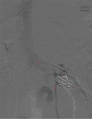 Figure 2. Venogram of distal duodenal ectopic varix status post varix outflow embolization with 0.35 interlock coil on HD3. Annotations as follows: I: IVC, II: Left renal vein, III: left gonadal vein, IV: absence of contrast into duodenum, V: 0.35 interlock coil filling DEV and outflow, absence of contrast distally in afferent feeders of DEV