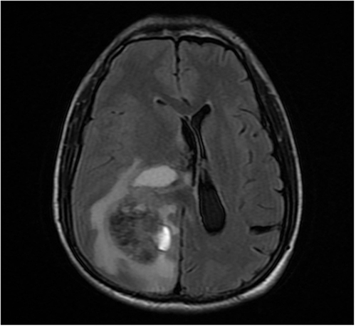 Figure 4 Male (43 years old) with headache and dizziness for six months. T2/fluid-attenuated inversion recovery showing the internal signal intensity of the mass is clear, and the edema is obvious around the mass.