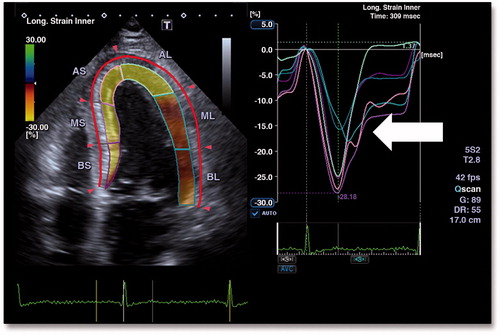 Figure 7. The automatic strain analysis in a patient with non-ST-segment elevation acute coronary syndrome with occluded circumflex (CX) artery in apical four-chamber view shows reduced color-coded endocardial strain values in the segments supplied by the CX artery on the left. The red line and the red arrowheads depict the border of the epicardium. Color-coding from yellow to green indicates strain from +30% to –30%. Yellow indicates preserved strain. Brown indicates areas with reduced strain. Strain curves for the six endocardial segments are displayed on the right. The curves representing the segments supplied by the CX artery show reduced strain values of –15% to –17% (white arrow). Endocardial global longitudinal strain was reduced in this patient to –15%. With permission from: Sarvari et al.[Citation42].