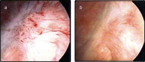Figure 3. The presence of a marker lesion prior to (A) and after (B) a 6 week course of apaziquone. The results were first presented in the review article by Phillips et al, reproduced with permission [Citation6].