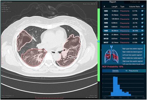 Figure 5 The working model of DL on chest CT for a forty-nine years old woman. The upper right panel shows the ratio of the total volume of lesions to lung volume, which was more than 95%. The three-dimensional display and the density of lesions were shown in the middle and the inferior of right panel. This COVID-19 patient was hospitalized again and presented with a positive nucleic acid test again.