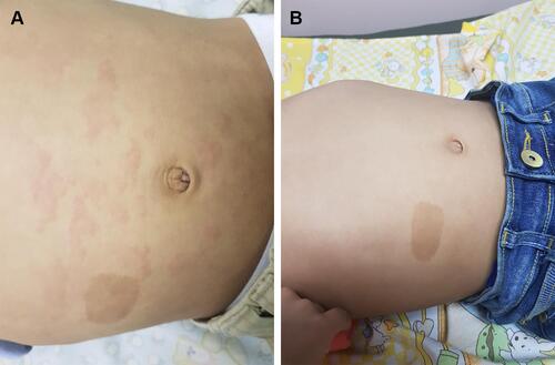 Figure 1 (A) Urticarial rash on the chest before treatment. (B) After treatment, the rash has disappeared.