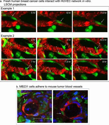 Figure 12. Fresh human breast cancer cells interact with HUVEC networks like MB-231 cells, and MB-231 cells in an MB-231 tumor generated in a mouse interact with tumor blood capillaries. (a) Fresh human breast cancer cells vitally stained with Green CMRA (green) in the proximity of a HUVEC network (red). Example 1, a human cancer cell translocating on the surface of a HUVEC branch. Example 2, human breast cancer cells penetrating the network (arrows point to the two cells). (b) Histological sections of MB-231 cells adhering to blood vessels in a tumor formed by MB-231 cells in a mouse mammary fat pad. MB-231 cells express GFP constitutively (green); nuclei are stained blue with DAPI; blood vessel cells are stained red with an anti-PECAM mAb