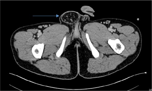Figure 2 Computerized tomography scan showing hernia extending through the scrotal sac (arrow).