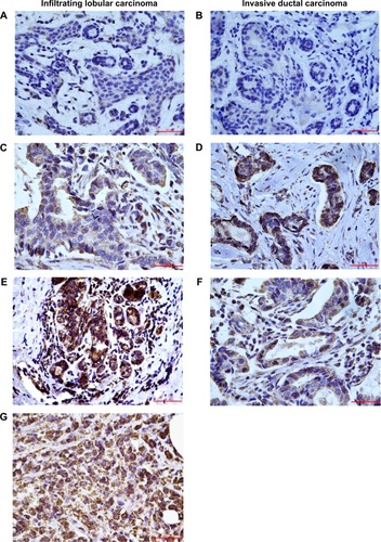 Figure 1 Expression of SHMT2 in breast cancer and its distant noncancerous tissues.