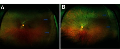 Figure 1 (A and B) Color fundus photograph of white without pressure.