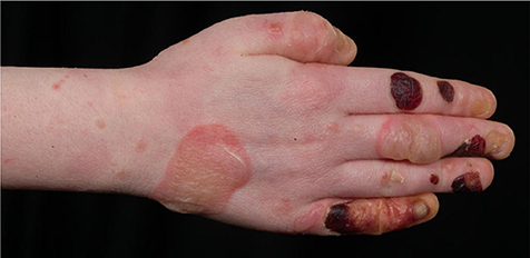 Figure 3 Right hand with new and some healing haemorrhagic blisters in a 6-year-old child with JEB-GI.