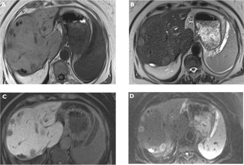 Figure 1 Metastases. Plain T1-weighted spoiled 2D gradient echo (GRE) A) T2-weighted half-Fourier acquisition single-shot turbo spin-echo (HASTE) B) hepatocellular phase gadoxetic acid-enhanced fat-suppressed (FS) T1-weighted spoiled 3D GRE C) and diffusion-weighted imaging (DWI) D) in the axial plane. Multiple liver metastases are better visualized on gadoxetic acid-enhanced magnetic resonance imaging (MRI) and also DWI compared to plain T1- and T2-weighted MRI.