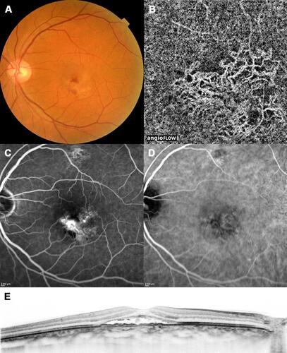 Figure 2 A case with pachychoroid neovasculopathy (before treatment). Images of the left eye of a 70-year-old man with pachychoroid neovasculopathy without any treatment history. The best-corrected visual acuity was 20/50. (A) Color fundus photograph shows subretinal hemorrhage and serous retinal detachment. Note that drusen are absent. (B) Optical coherence tomography (OCT) angiography image shows choroidal neovascularization (CNV). (C) Late-phase fluorescein angiography image shows leakage suggesting occult CNV. (D) Late-phase indocyanine green angiography image. (E) Enhanced-depth imaging OCT image shows serous retinal detachment and elevation of the retinal pigment epithelium, suggesting CNV. The choroid is thick throughout the macula, and choroidal vessels are dilated. Subfoveal choroidal thickness = 387 μm, central retinal thickness = 317 μm.