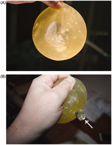 Figure 1. Illustration of the ruptured PIP implant. (A) A yellow implant without signs of rupture and with visible air bubbles inside indicating possible microruptures of the implant shell. (B) Ruptured PIP device with leakage of the silicone gel after manual compression