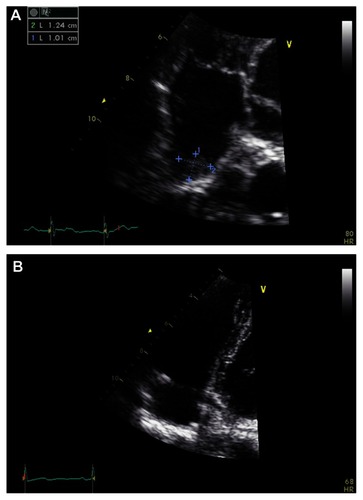 Figure 2 Echocardiogram showing (A) mobile thrombus in right atrium, and (B) 1 month after methylprednisolone and anticoagulation therapy.