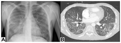 Figure 2 Radiological findings in patient with acute pulmonary AMR.