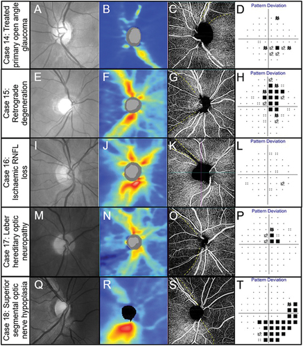 Figure 8. Spectrum of optic nerve head diseases. (Case 14) Primary open angle glaucoma in the left eye of a 63-year-old male. (A) Broad superior RNFL defect with red-free photography. (B) Superior RNFL thinning with OCT RNFL thickness map. (C) 4.5 × 4.5 mm OCT-A superficial slab (defined as inner limiting membrane to posterior inner plexiform layer) shows reduced capillary perfusion corresponding to the RNFL thinning (dashed lines). (D) Inferior arcuate-like defect using the 24–2 visual field test grid corresponding to the structural loss. (Case 15) Retrograde degeneration in a 60-year -old male. (E) Temporal reduction in RNFL reflectivity in the right eye evident from the red-free image. (F) Concordant RNFL thinning with OCT RNFL thickness map. (G) Temporal reduction in capillary perfusion corresponding to location of RNFL thinning with 4.5 × 4.5 mm OCT-A superficial slab (dashed lines). (H) Right vertical central midline field loss with the 30–2 test grid. (Case 16) Ischaemic retinal nerve fibre layer loss in a 53-year-old female. (I) Superotemporal RNFL defect in the right eye evident from the red-free image. (J) Focal superotemporal RNFL thinning not contiguous with the disc on OCT RNFL thickness map. (K) Deep and focal reduction in capillary density in the region of RNFL thinning (dashed lines) using 4.5 × .4.5 mm OCT-A superficial slab. (L) No associated functional loss detected with the 24–2 test grid possibly due to the narrow RNFL loss and the course test grid (test spots are 6 degrees apart and the defect is roughly 3 degrees wide around 10 degrees from the ONH). (Case 17) Leber hereditary optic neuropathy in a 60-year-old male. (M) Temporal reduction in RNFL reflectivity in the right eye evident from the red-free image. (N) Temporal RNFL thinning, more marked inferiorly than superiorly with OCT RNFL thickness map. (O) 4.5 × 4.5 mm OCT-A superficial slab shows marked reduction in capillary perfusion temporally (dashed lines). (P) Superior paracentral defect on the 30–2 test grid. (Case 18) Superior segmental optic nerve hypoplasia in a 40-year-old male. (Q) Marked reduction in RNFL reflectivity in the superior and nasal peripapillary regions in the right eye shown in the red-free image. (R) Superior and nasal RNFL thinning on OCT RNFL thickness map. (S) Marked reduction in capillary perfusion in the regions of RNFL thinning with 4.5 × 4.5 OCT-A superficial slab (dashed lines). (T) Deep inferotemporal visual field defect on the 30–2 test grid. The key visual characteristics for these cases are: Case 14, visual acuity 6/6 R and L: mean deviation (MD) −3 dB L (24–2 test grid) and MD −7 dB (10–2 test grid); Case 15, visual acuity 6/7.5 R and L: MD R −4.4 dB L −5.6 dB (24–2 test grid); Case 16, visual acuity 6/6 R and L: MD R −0.6 dB L −0.3 dB (both 24–2 test grid); Case 17, visual acuity 6/38 R 6/48 L: MD −1.74 dB R and −4.73 L (both 24–2); Case 18, visual acuity 6/6 R and L: MD −8.53 dB R and −11.14 dB L (both 24–2 test grid).