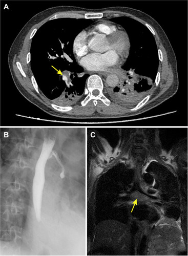 Figure 1 Imaging appearances in case 1. (A) Enhanced chest computed tomography (CT) showing the pulmonary thromboembolism (arrow) in right inferior pulmonary artery and bilateral pleural effusion. (B) Iodine contrast esophagogram confirmed the bronchoesophageal fistula. (C) Coronal magnetic resonance imaging (MRI) showed the mediastinal soft tissue shadows (arrow) surrounded the left main bronchus.