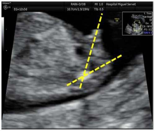 Figure 1 Male sex: ultrasound identification of the male sex at the first trimester ultrasound scan shows tubercle’s angle >30°.