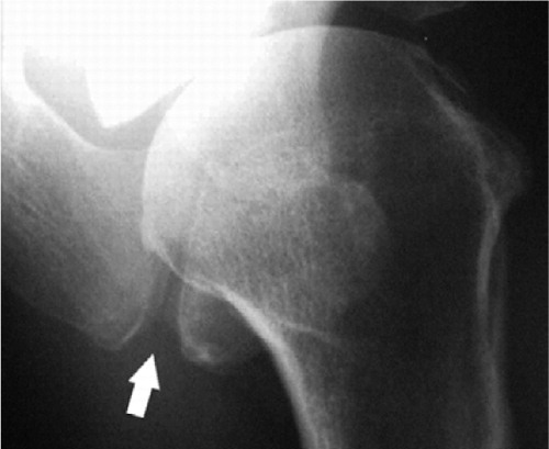 Figure 1b. Axillary radiograph of a right shoulder with an os meso-acromiale. The white arrow indicates the non-ossified gap between the os meso-acromiale and the acromion.